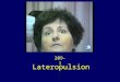 Lateropulsion 209-1. Lateropulsion (deviation) of the eyes towards the side of the lesion, under closed lids