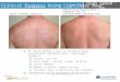 Clinical Progress Using LightSheer Duet ‘High Speed’ hp Courtesy of Mitch Goldman, MD Dr. Mitch Goldman’s back is currently being treated with LightSheer