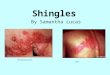 Shingles By Samantha Lucas Poisonevercure NLM. Background Information Shingles is a skin rash caused by the same virus that causes chickenpox. The virus