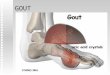 GOUT. Gout is a familial metabolic disease characterized by recurrent episodes of acute arthritis due to deposits of monosodium urate crystals. The metatarsophalangeal