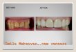 Smile Makeover….new veneers BEFORE AFTER. Smile Makeover….new crowns BEFOREAFTER