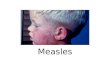 Measles. Etiology Measles virus is a spherical, nonsegmented, single- stranded, negative-sense RNA virus Morbillivirus genus in the family of Paramyxoviridae