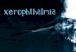 Xerophthalmia Literaly means “dry eye” Literaly means “dry eye” Ocular abnormalities from vitamin A deficiency (nutritional deficiency) Ocular abnormalities