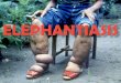 Elephantiasis is a disease that is characterized by the thickening of the skin and underlying tissues, especially in legs and male genitals.  In some