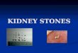 KIDNEY STONES. WHAT IS A KIDNEY STONE?? Solid piece of material that forms in kidney out of substances in the urine. Solid piece of material that forms