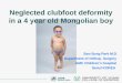 Neglected clubfoot deformity in a 4 year old Mongolian boy Soo-Sung Park M.D Department of Orthop. Surgery AMC Children’s hospital Seoul KOREA