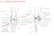 R x - â€œUnhappy Triadâ€‌ Knee Injury femur tibia fibula tibial tuberosity articular cartilage lateral meniscus medial meniscus lateral meniscus articular