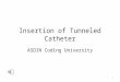 Insertion of Tunneled Catheter ASDIN Coding University 1