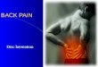 BACK PAIN Disc herniation. History Primitive cultures attributed it to the work of demons Ancient Greeks recognized the symptoms as a disease Goldthwait