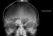 Identify the abnormality. Depicts a growth in the right frontal sinus