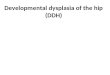 Developmental dysplasia of the hip (DDH). Definition Dysplasia of the hip that develop during fetal life or in infancy. It ranges from dysplasia of the