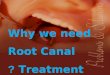 Why we need Root Canal Treatment ?. Aetiology of the pulp and periapical pathosis Microbial : dental caries Mechanical : operative procedure (iatrogenic),