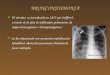 BRONCONEUMONIA El término es introducido en 1837 por Seiffert3, a través de la idea de infiltrados pulmonares de origen broncogénico o bronquiologénico