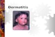 Dermatitis. Dermatitis Es una inflamación de la piel causada por la exposición a una sustancia irritante. El grado de inflamación es afectado por el tipo
