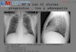 M 47 a con CC disnea progresiva , tos y adenopatía retro auricular