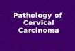 Pathology of  Cervical Carcinoma