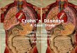 Crohn’s  Disease A Case Study