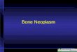 Bone Neoplasm