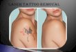 Laser Tattoo Removal Santa Monica | Affordable Tattoo Removal Santa Monica