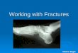 Working with Fractures Click to Begin. Working with Fractures Click to Continue