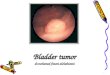 Bladder tumor dr,mohamed fawzi alshahwani 1. facts Bladder cancer is the second most common cancer of the genitourinary tract.Bladder cancer is the second