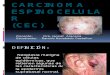 Carcinoma Espinocelular Exposicion Ramiro