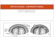 Epidural Hematoma 8-15