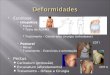 Escoliose  Idiopática  Rígida  Teste de ADAMS  Tratamento – Colete e/ou cirurgia (artrodeses)  Postural  Móvel  Tratamento – Exercícios e orientação