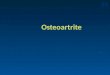 Osteoartrite.. Definição Distúrbio extremamente comum, podendo estar relacionado ao envelhecimento Afeta principalmente mãos, joelhos, quadris e coluna