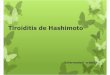 Tiroiditis de Hashimoto.pptx