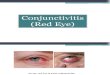 Conjunctivitis of Eye.jn21.02.11