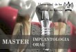 Máster en Implantología Oral