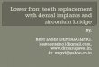 Lower front tooth replacement with dental implants