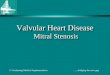 Valvular Heart Disease Mitral Stenosis
