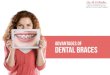 Advantages Of Dental Braces