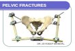 Pelvic fractures classification and management