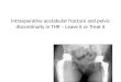 Intraoperative acetabular fracture and pelvic discontinuity in thr