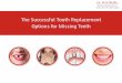 The Successful Tooth Replacement Options for Missing Teeth