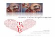 Aortic Valve Replacement - Sostituzione Valvola Aortica