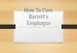 How to cure barrett’s esophagus | Natural Remedies to Cure Barrett's Esophagus