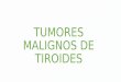Tumores malignos de tiroides