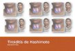 Tiroiditis de hashimoto