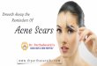 Laser treatment for Acne Removal In Bangalore | Skin Specialist In India