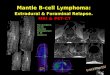Mantle B-Cell Lymphoma: Extradural & Foraminal Relapse