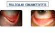 Follicular conjunctivitis (1)