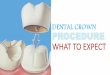 Dental Crown Procedure - What to Expect