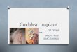 Cochlear implant 1