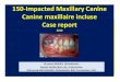 150 impacted maxillary canine-canine incluse -case report sandid -cas cliniques sandid-deepbite in orthodontic-supraclusion en orthodontie-mohamad-aboualnaser-awatef shaar-oussama