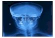 Web viewA cada lado del foramen magno: se observan los cóndilos del occipital, que se articulan con las carillas articulares superiores del atlas. En su extremo posterior
