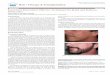 Facial Hair Restoration: Effective Techniques for Beard ... hair restoration are for poorly thought out prior laser hair removal, scarring, burn, or cleft lip repair ... technique